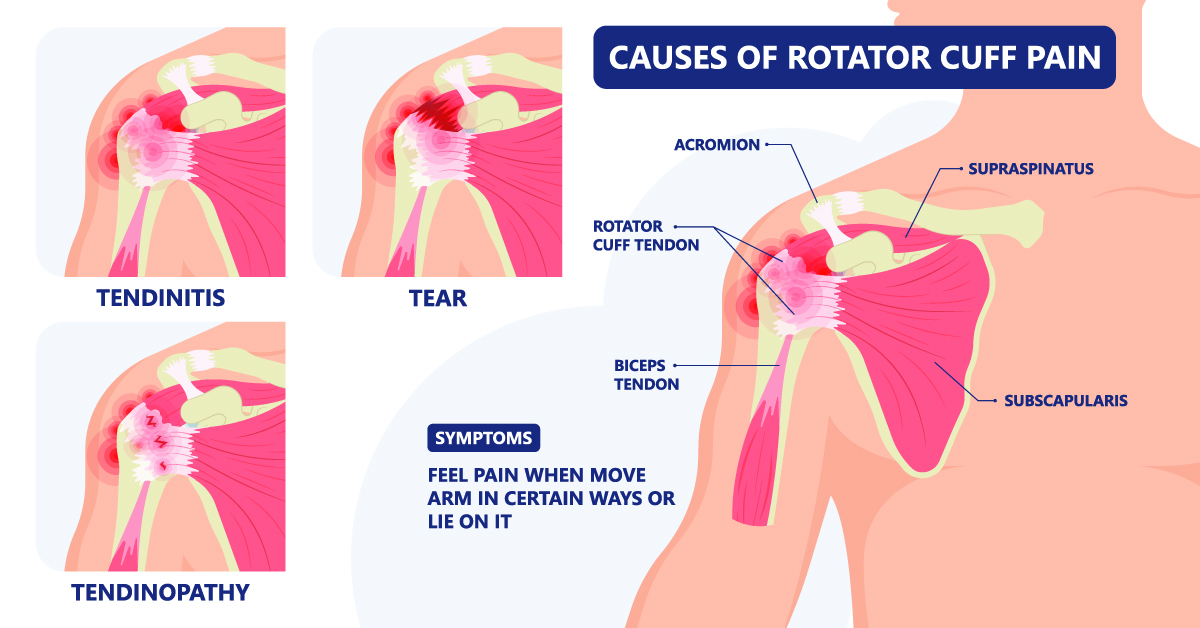 Causes of Rotator Cuff Pain