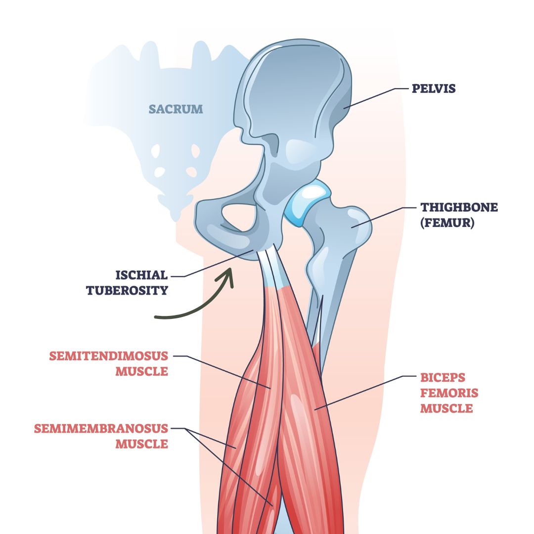 ischial bursitis