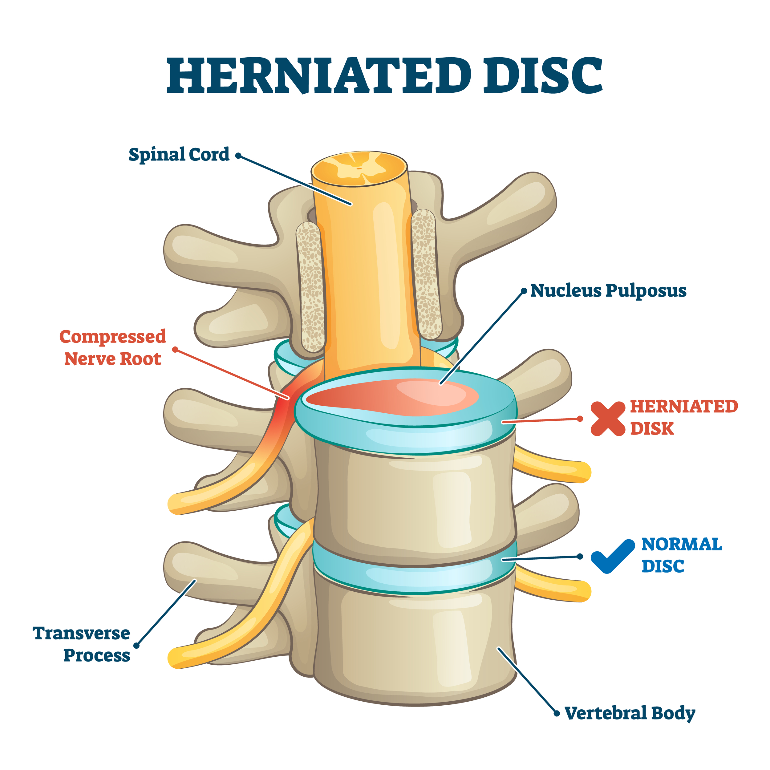 disc herniation